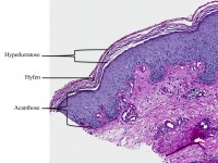 Dermatomycose, PAS kleuring