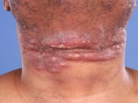 Dermatomycosis barbae, tinea barbae