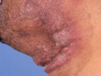 Dermatomycosis barbae, tinea barbae