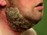 Dermatomycosis barbae, tinea barbae