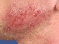 Dermatomycosis barbae, tinea barbae