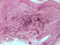 Histologie van dermatomycosis barbae, tinea barbae