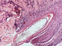 Histologie van dermatomycosis barbae, tinea barbae