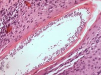 Histologie van dermatomycosis barbae, tinea barbae