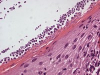 Histologie van dermatomycosis barbae, tinea barbae