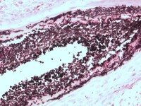 Histologie van dermatomycosis barbae, tinea barbae