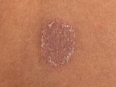 Ringworm, tinea corporis, dermatomycosis