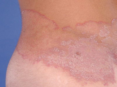 Ringworm, tinea corporis, dermatomycosis