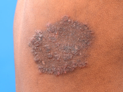 Ringworm, tinea corporis, dermatomycosis