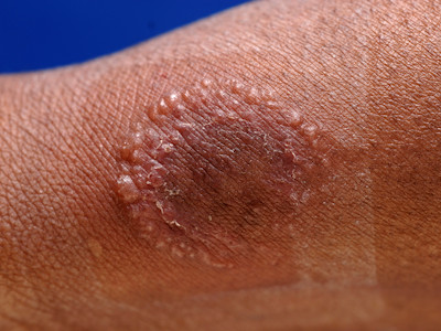 Ringworm, tinea corporis, dermatomycosis