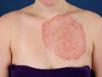 Ringworm, tinea corporis, dermatomycosis