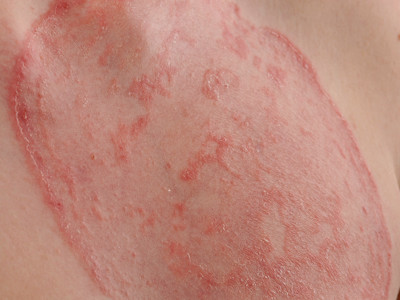 Ringworm, tinea corporis, dermatomycosis
