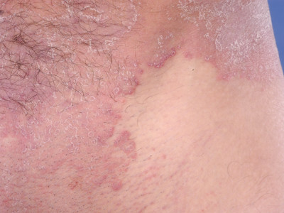 Ringworm, tinea corporis, dermatomycosis