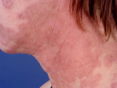 Ringworm, tinea corporis, dermatomycosis