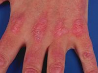 Dermatomyositis