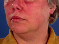 Dermatomyositis