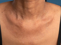Dermatomyositis