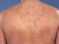 Dermatomyositis