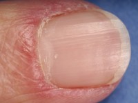 Beschadigde cuticula bij dermatomyositis