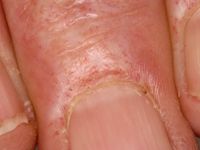 Dermatomyositis