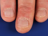 Periunguale dermatitis bij dermatomyositis