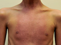 Dermatomyositis