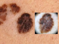 Superficial spreading melanoom onder de dermatoscoop