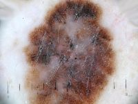 Superficial spreading melanoom onder de dermatoscoop