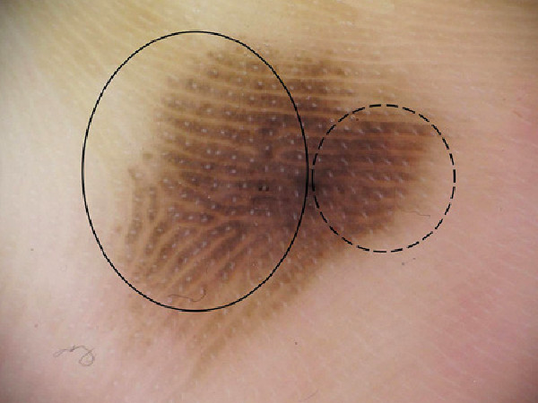 Parallel ridge pattern