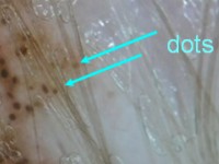 Dots en globules dermatoscopie