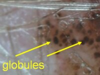 Dots en globules dermatoscopie