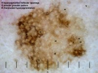 Dermatoscopie van een lentigo maligna