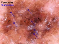 Dermatoscopie van een lentigo maligna