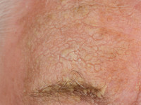Dermatosis neglecta