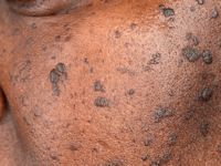 Dermatosis papulosa nigra