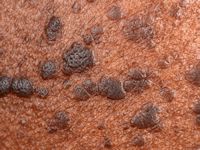 Dermatosis papulosa nigra
