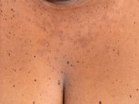 Dermatosis papulosa nigra