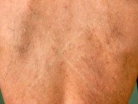 Dermatographie blanche