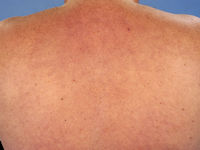 Dermatographie blanche