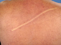 Dermatographie blanche