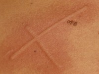 Dermographism (urticaria factitia)