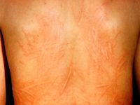 Dermographism (urticaria factitia)