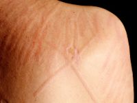 Dermographism (urticaria factitia)