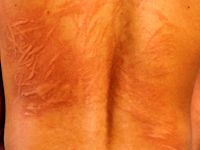 Dermografisme (urticaria factitia)
