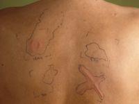 Dermografisme (urticaria factitia)