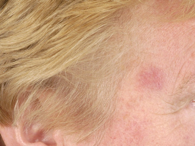 Desmoplastisch melanoma