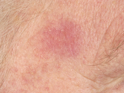 Desmoplastisch melanoma