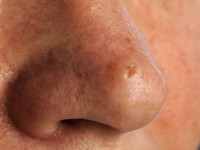 Desmoplastisch trichoepithelioma