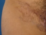 hidradenitis after deroofing