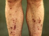 Pretibial pigmented patches